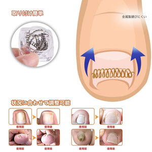 巻き爪矯正チェーン